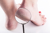 How to Cure Cracked Heels