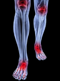 Rheumatoid Arthritis May Affect the Feet