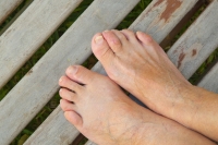 How Common Are Hammertoes?