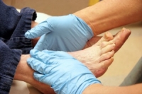 Risks of Charcot Foot in Diabetics