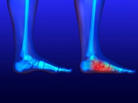 Possible Causes of Flat Feet