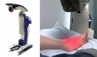 MLS Laser Therapy May Help Chronic Foot Pain