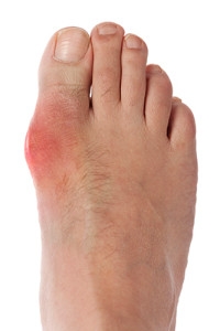New Study Shows Gout Not Related to Foot Fractures