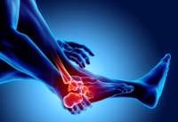 Rheumatoid Arthritis in Different Parts of the Foot
