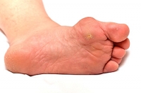 Overview of Plantar Warts