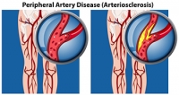 Is Peripheral Artery Disease Dangerous?