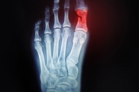 Symptoms and Appearance of a Broken Toe